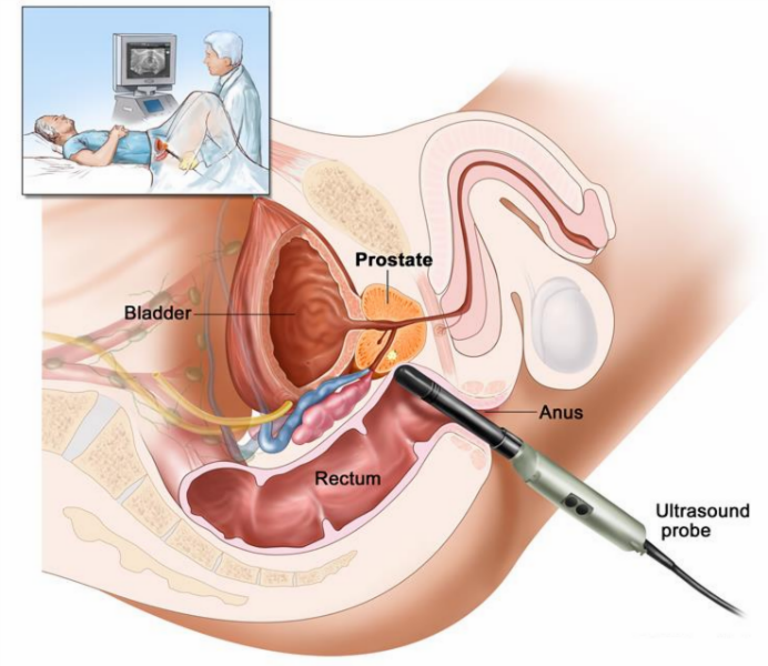 ecografie uretrala ce este prescris pentru prostatita la bărbați