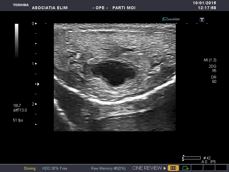ecografie testiculara - Ecografie scrotală și erecție